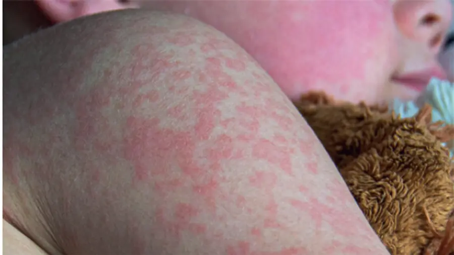 measles outbreak in us