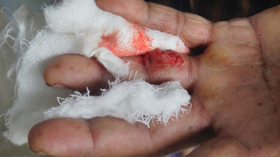 തെരുവുനായയുടെ ആക്രമണത്തിൽ ഹംസയുടെ കൈയിലുണ്ടായ മുറിവ്‌