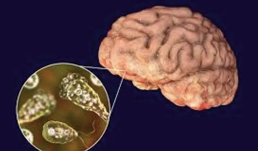 Amoebic Meningoencephalitis