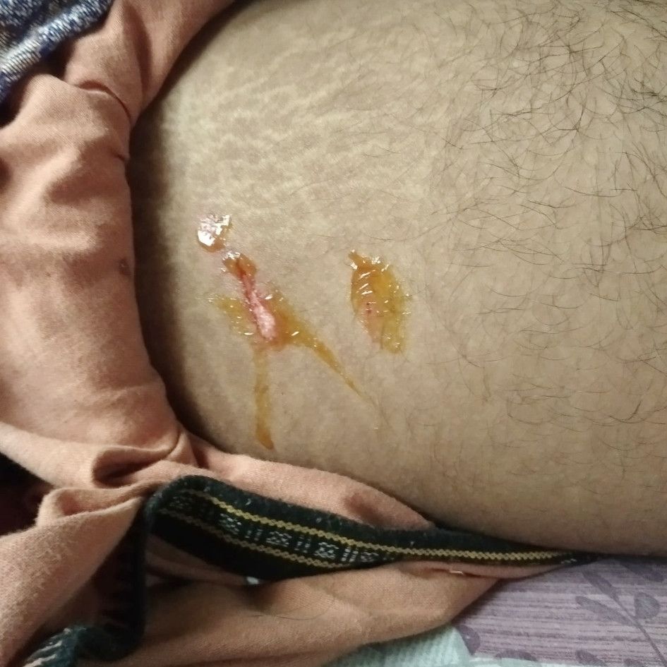 തെരുവുനായയുടെ കടിയേറ്റ  ദേവനന്ദിന്റെ കാൽ