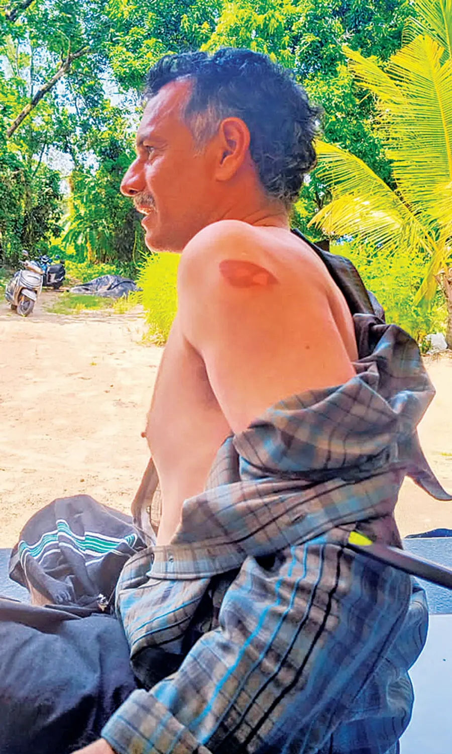 കൈയ-്ക്ക് സൂര്യാതപമേറ്റ് പൊള്ളിയ  ജോസഫ് (മനോജ്‌)