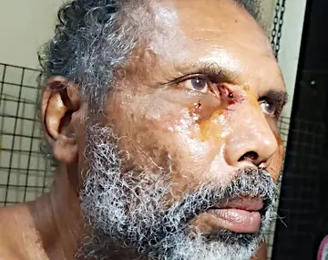 പേപ്പട്ടിയുടെ ആക്രമണത്തിൽ
കണ്ണിന് പരിക്കേറ്റ അഹമ്മദ് കുഞ്ഞ്