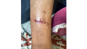 Bitten by a stray dog.