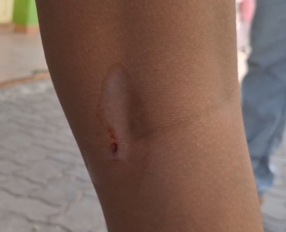 സെയിന്‍ മാത്യുവിന്റെ കാലിലെ  നായ കടിച്ച മുറിവ് 