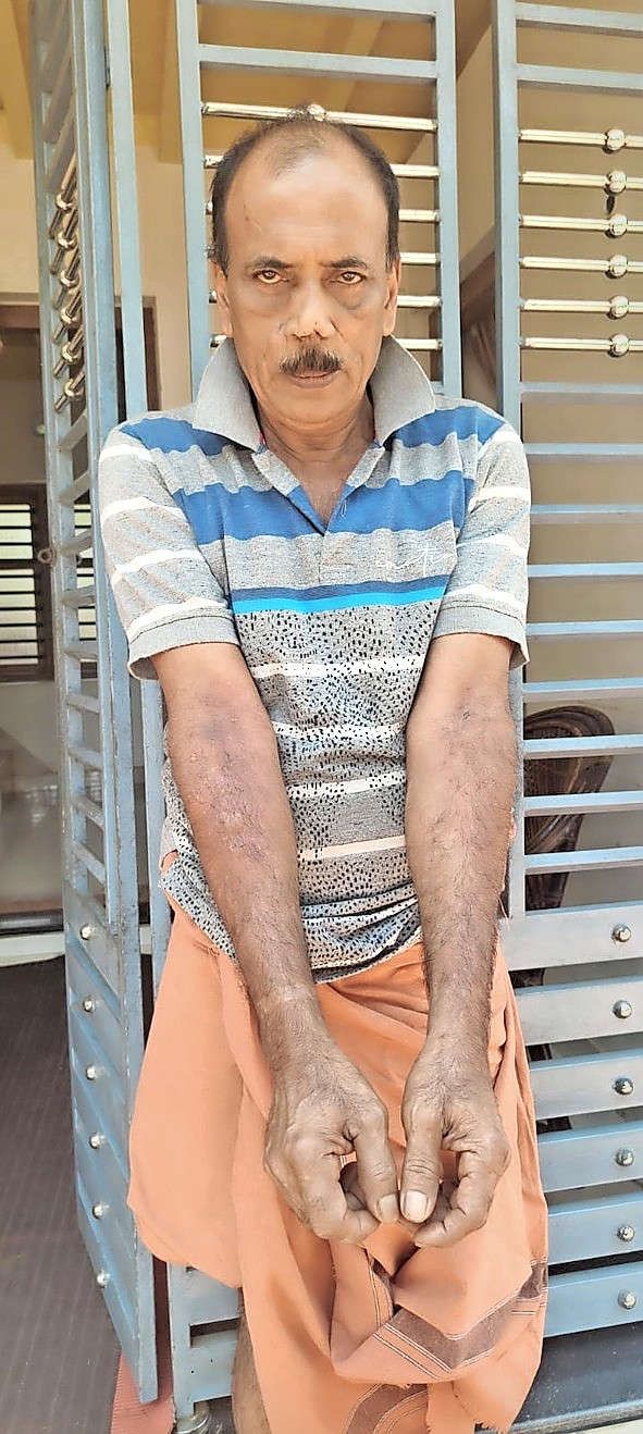 മധുസൂദനന്റെ കൈകൾക്ക്  പൊള്ളലേറ്റ നിലയിൽ