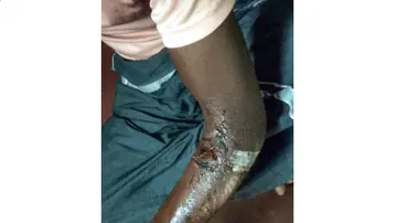 Stray dog attack