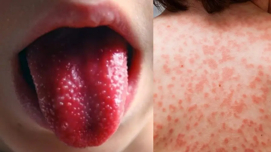 Kawasaki disease