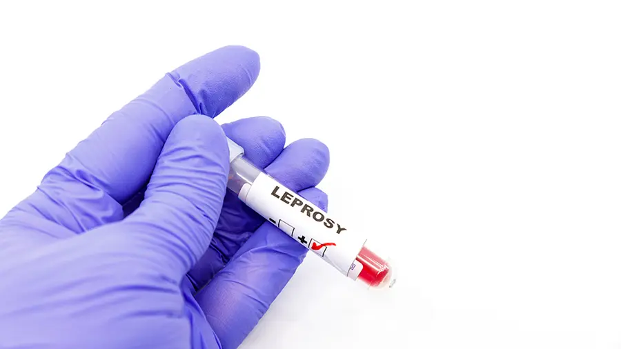 Leprosy