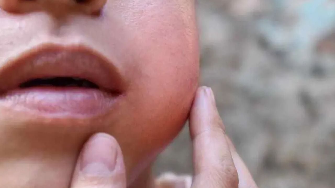 Mumps.jpg