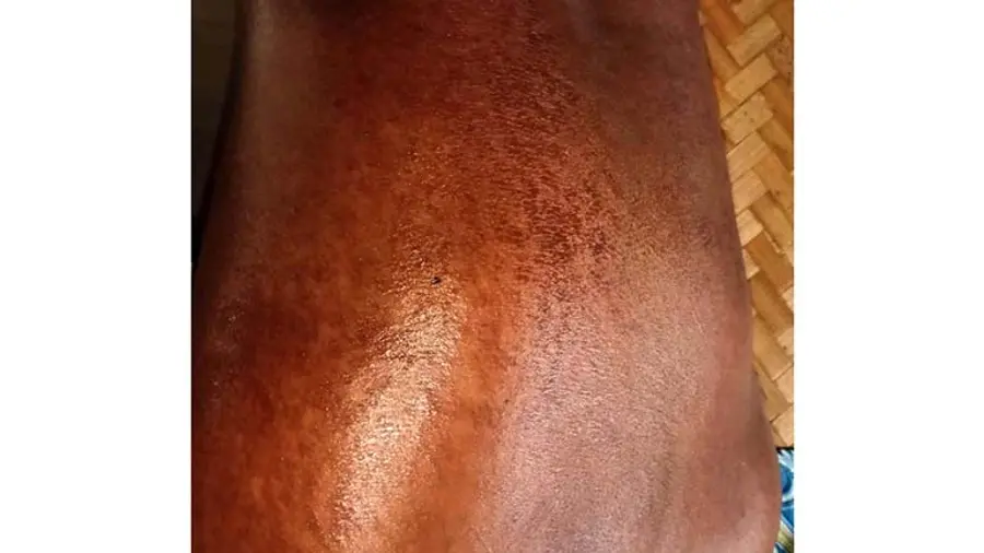 Sunburned