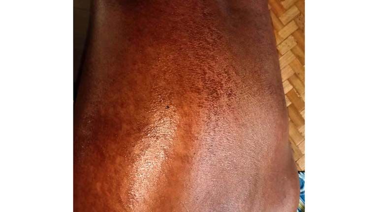 Sunburned