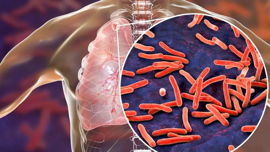 TUBERCULOSIS