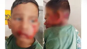 Thrithala stray dog attack bilal