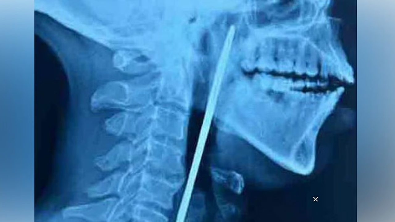 X RAY