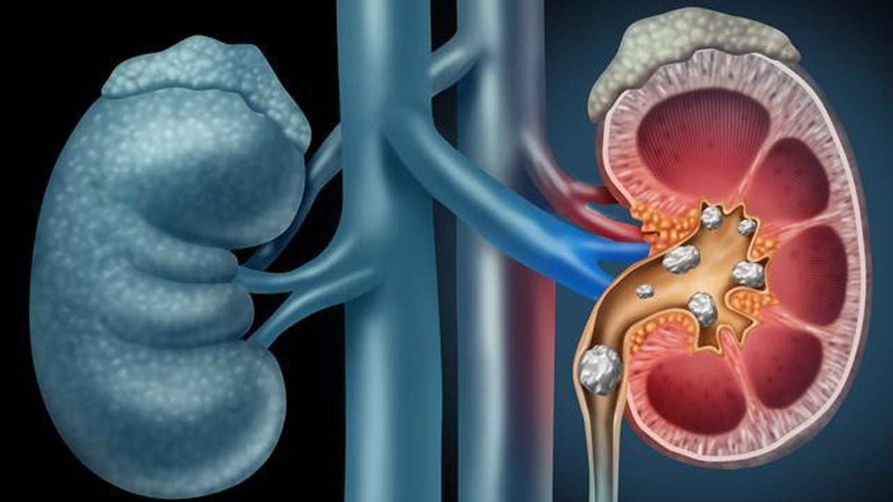 kidney stone