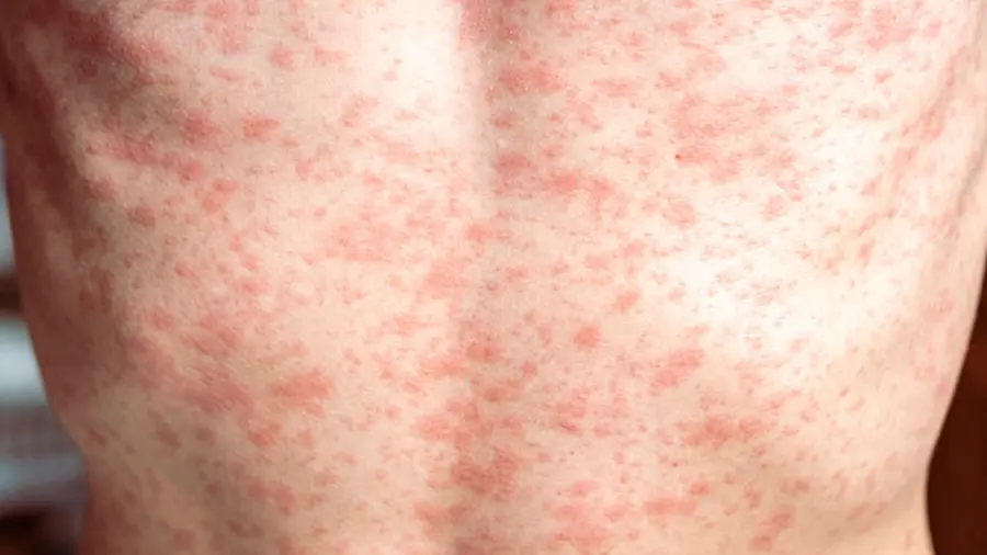 measles