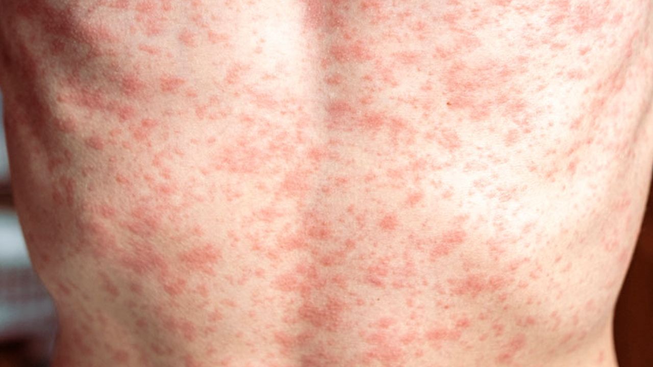 measles