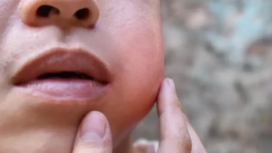 mumps