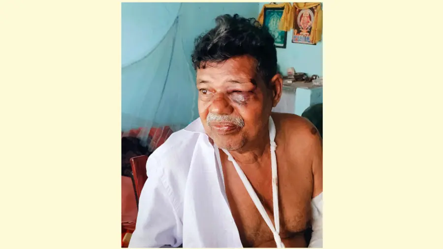 പൊള്ളലേറ്റ ശശിധരൻ നായർ