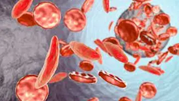 sickle-cell-disease