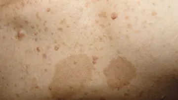 skin deseses