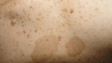 skin spots and birthmarks