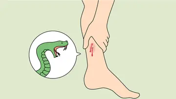 snake  bite