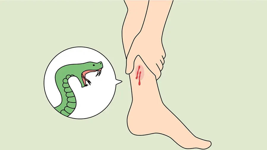 snake  bite