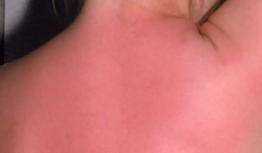 sun burn.