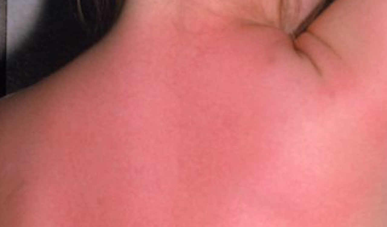 sun burn.