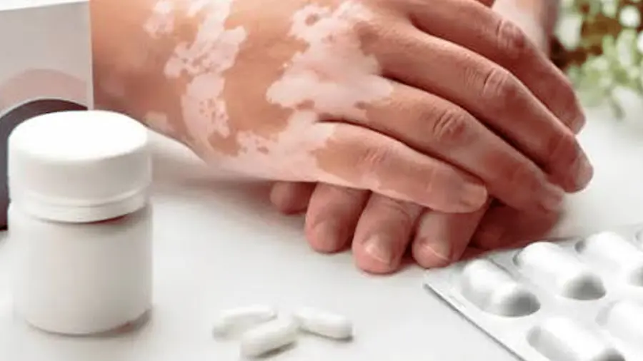 vitiligo